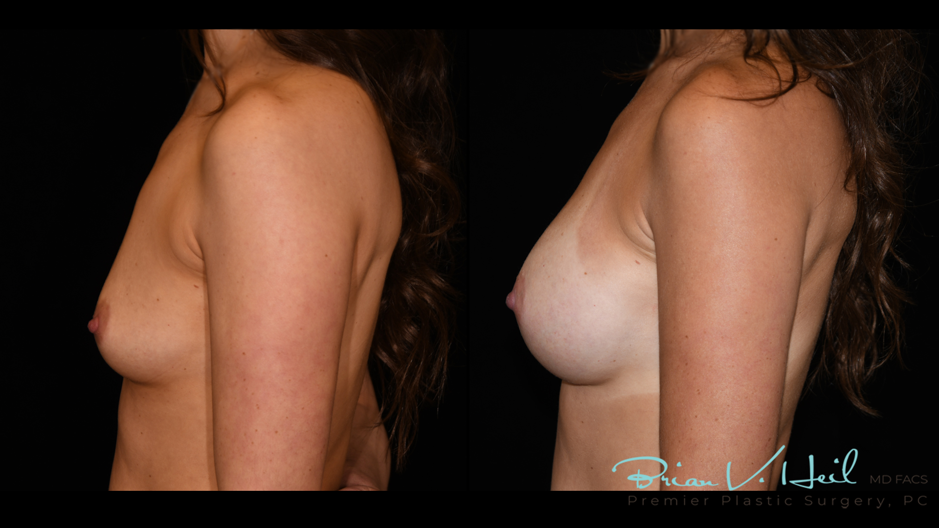 Breast Augmentation With Lift Before and After | Premier Plastic Surgery