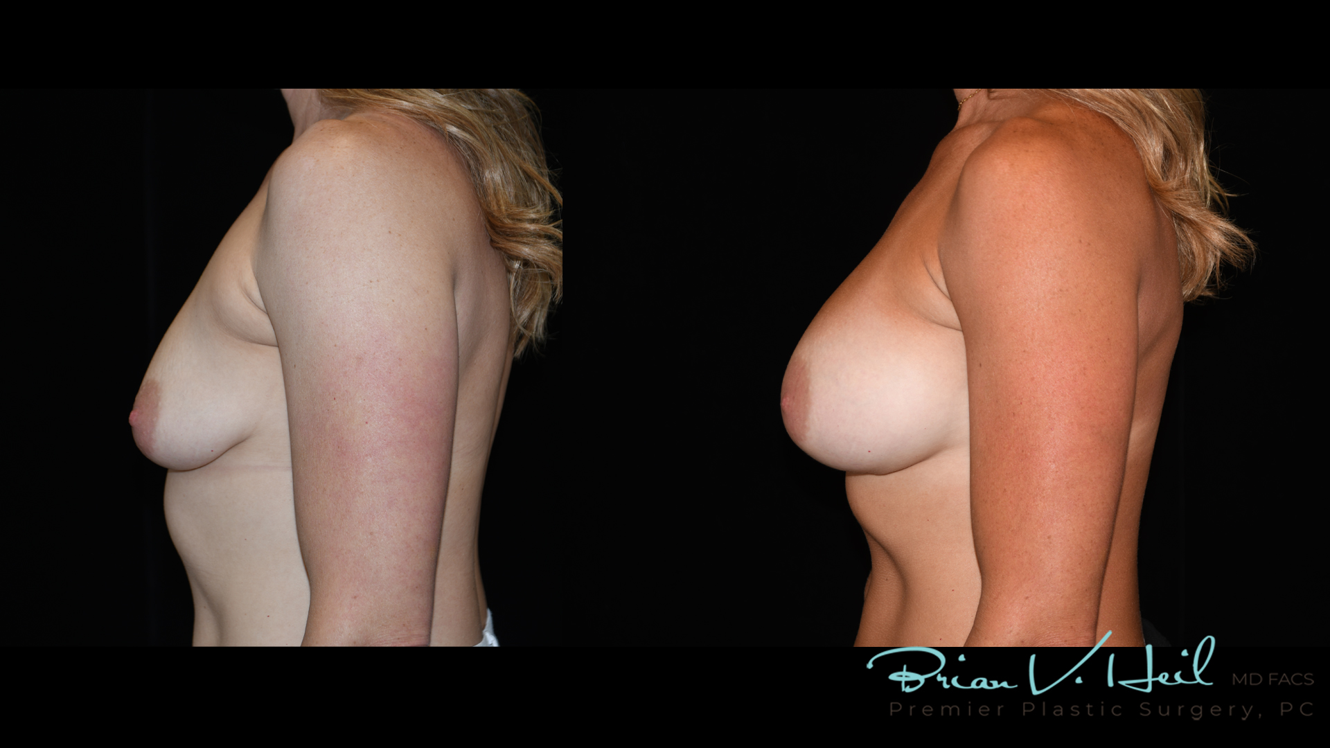 Breast Augmentation With Lift Before and After | Premier Plastic Surgery
