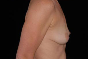 Breast Augmentation Before and After | Premier Plastic Surgery