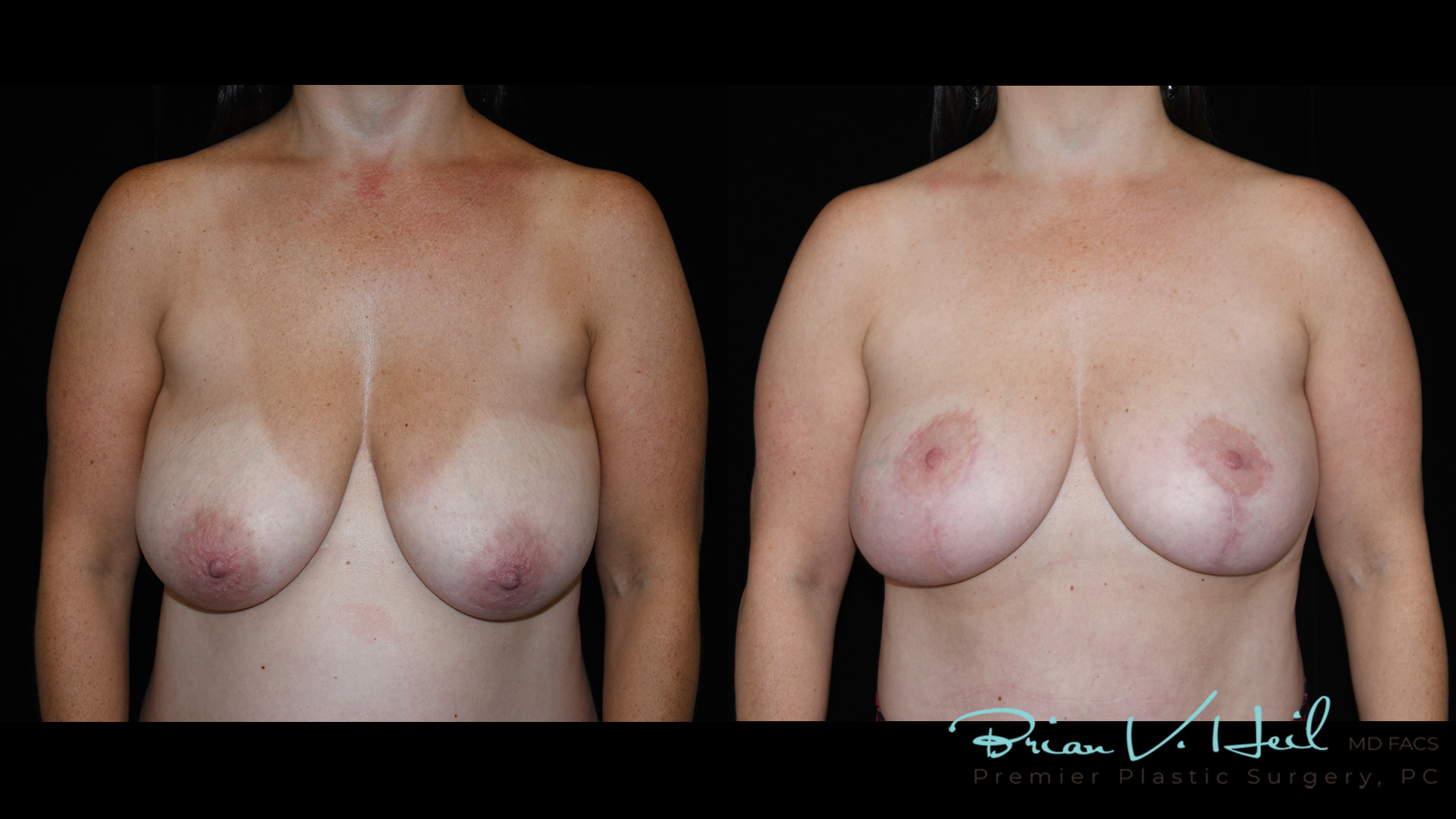 Breast Lift Surgery in Pittsburgh, PA