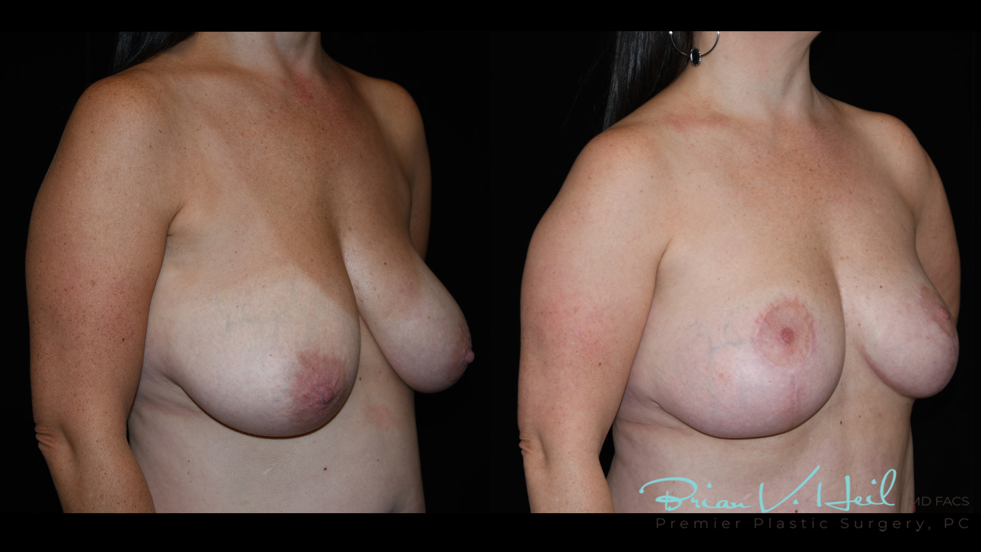 Breast Lift Surgery in Pittsburgh, PA