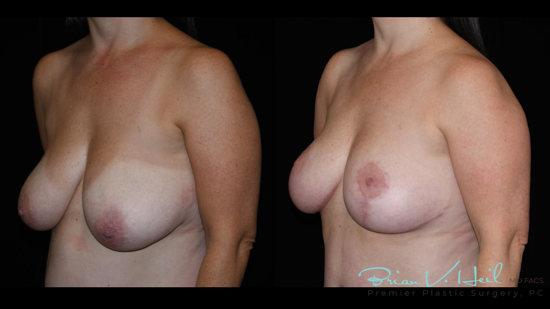 Breast Lift Before and After | Premier Plastic Surgery