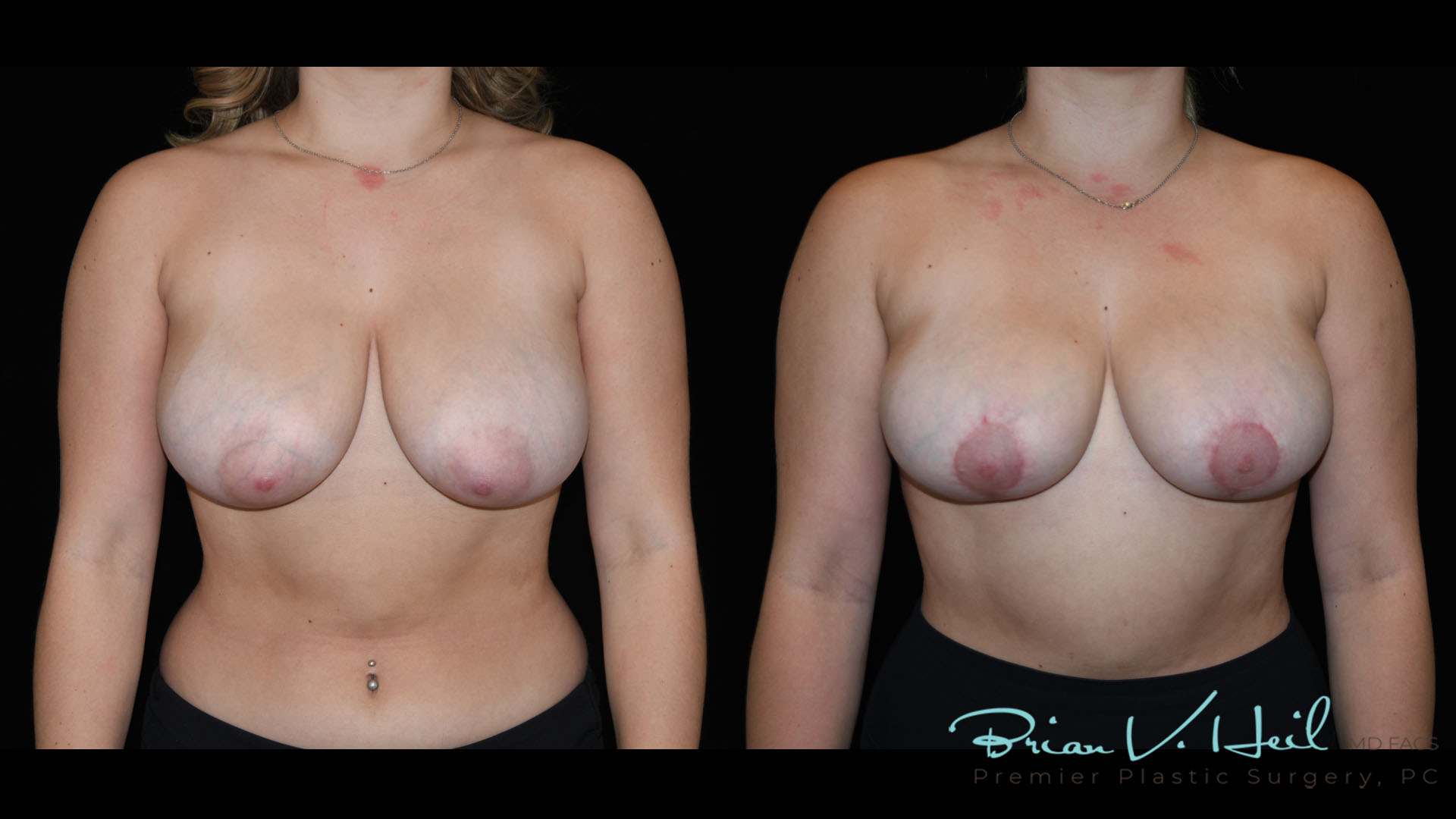 Breast Lift Surgery in Pittsburgh, PA