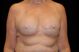 Breast Reconstruction in Pittsburgh, PA