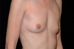Breast Reconstruction Before and After | Premier Plastic Surgery