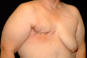 Breast Reconstruction Before and After | Premier Plastic Surgery