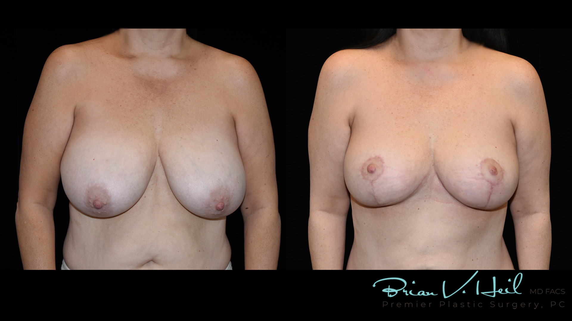 Breast Reduction in Pittsburgh, PA