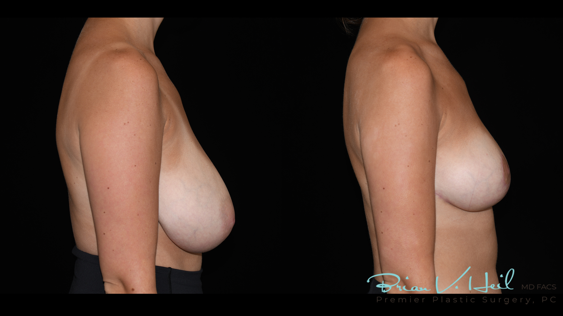 Breast Reduction in Pittsburgh, PA