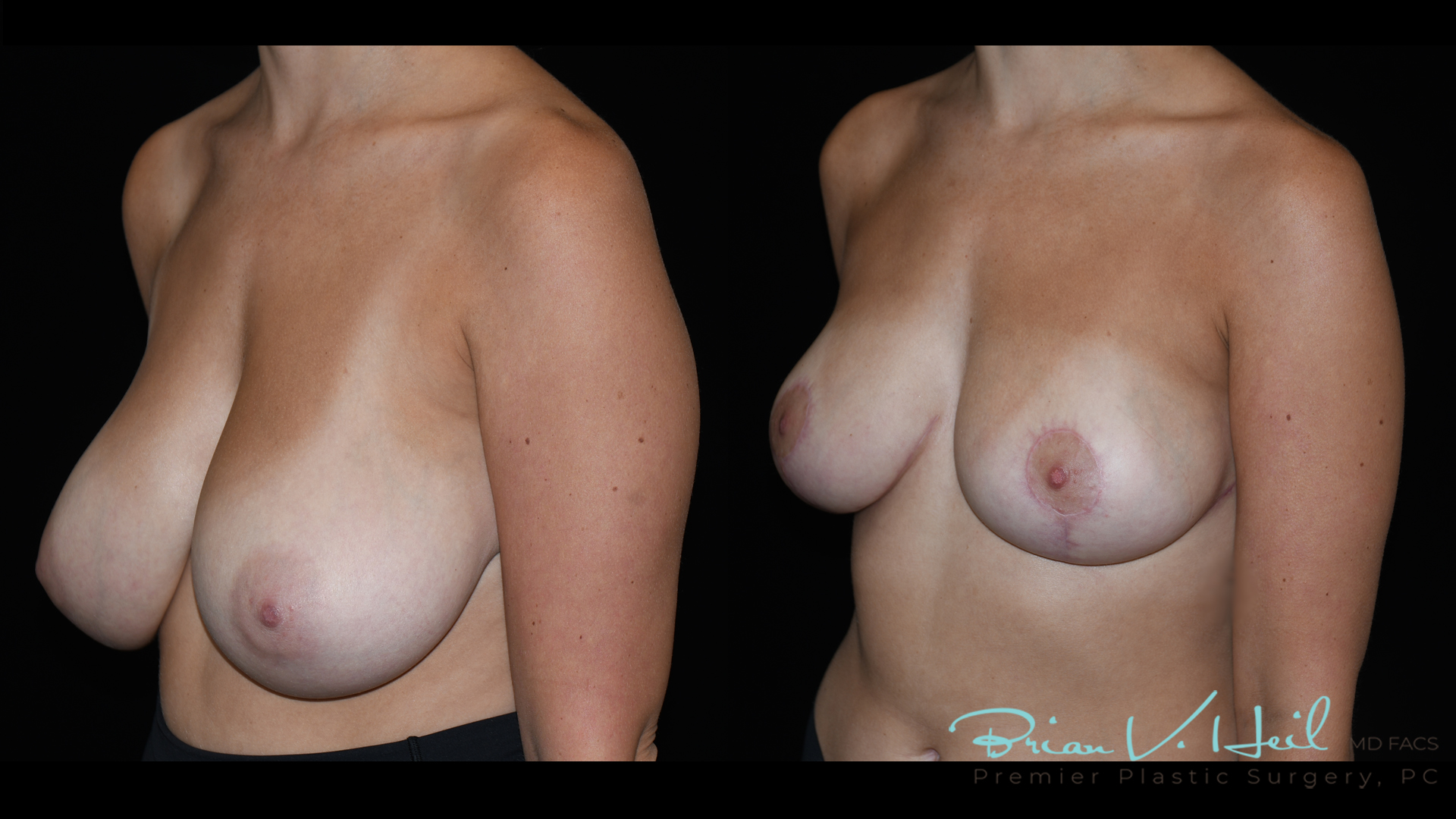 Breast Reduction Before and After | Premier Plastic Surgery