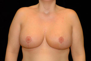 Breast Reduction Before and After | Premier Plastic Surgery