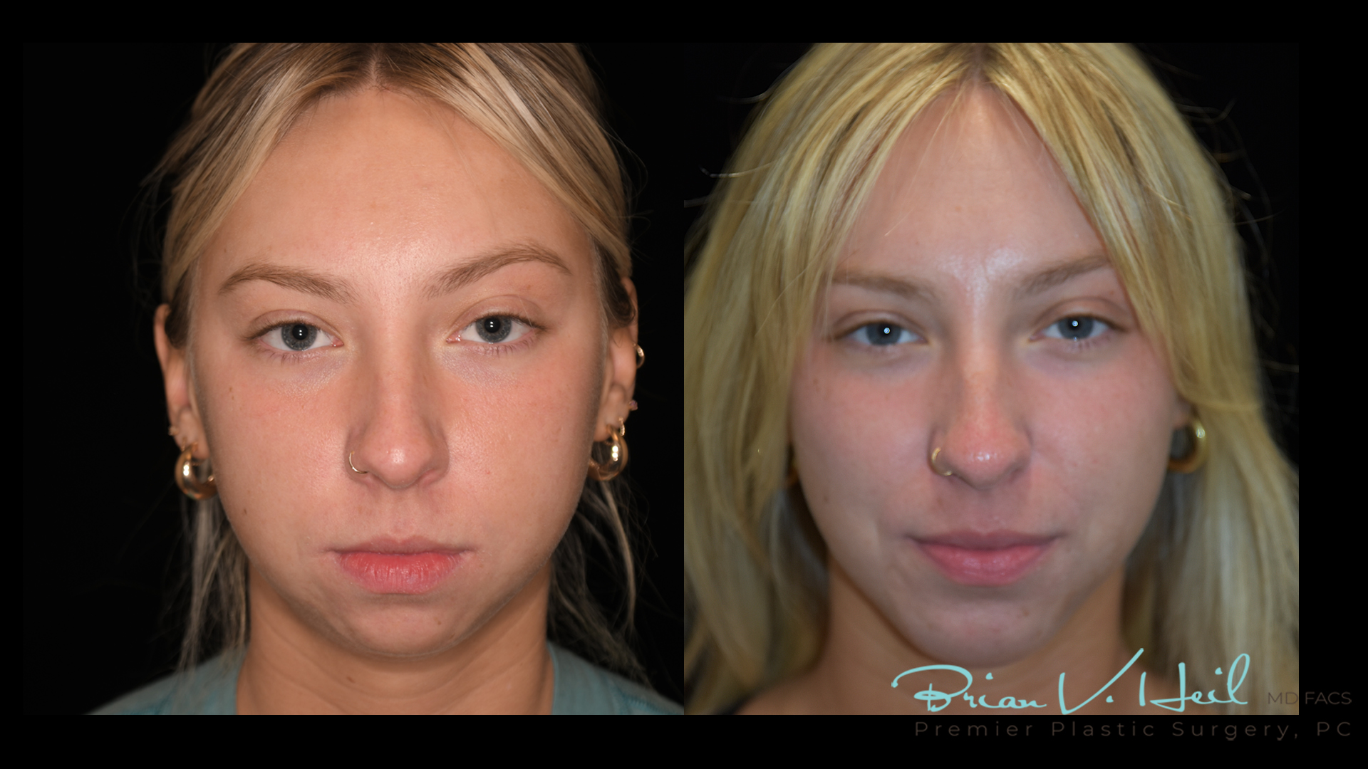 Facial Implants Pittsburgh