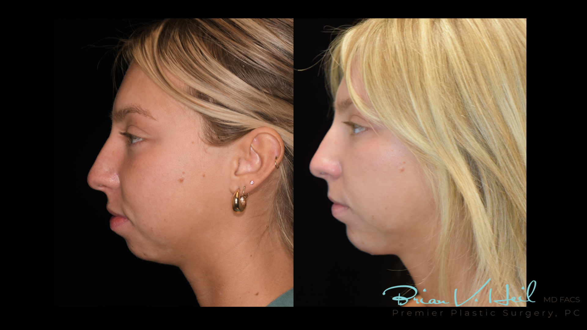 Facial Implants Pittsburgh