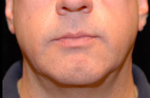 Chin Augmentation Before and After | Premier Plastic Surgery