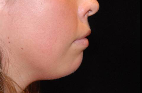 Chin Augmentation Before and After | Premier Plastic Surgery
