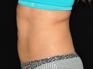 Coolsculpting Before and After | Premier Plastic Surgery