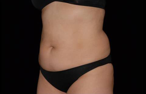 Coolsculpting Before and After | Premier Plastic Surgery