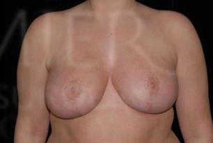 Cosmetic Breast Reduction Before and After | Premier Plastic Surgery