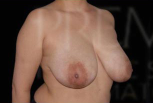Cosmetic Breast Reduction Before and After | Premier Plastic Surgery