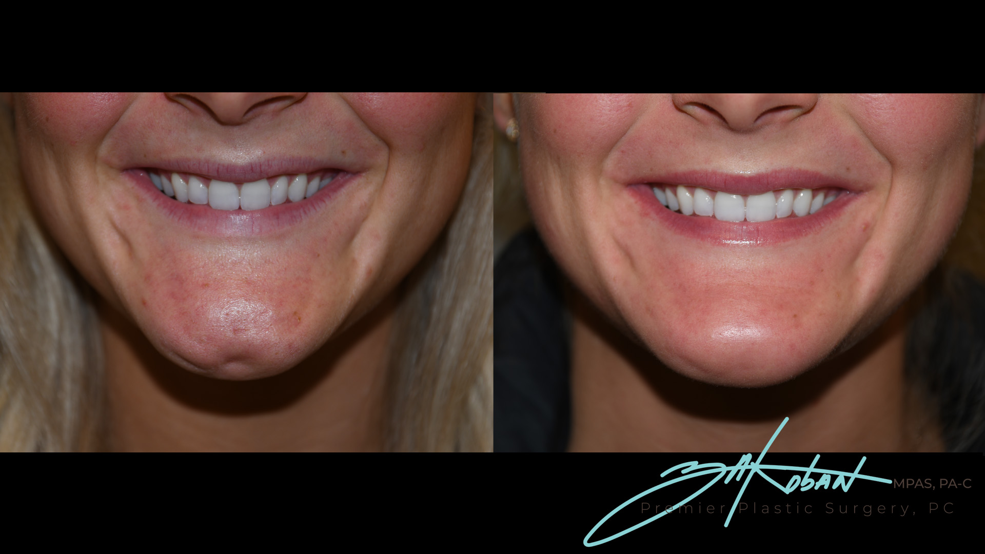 Dysport Before and After | Premier Plastic Surgery