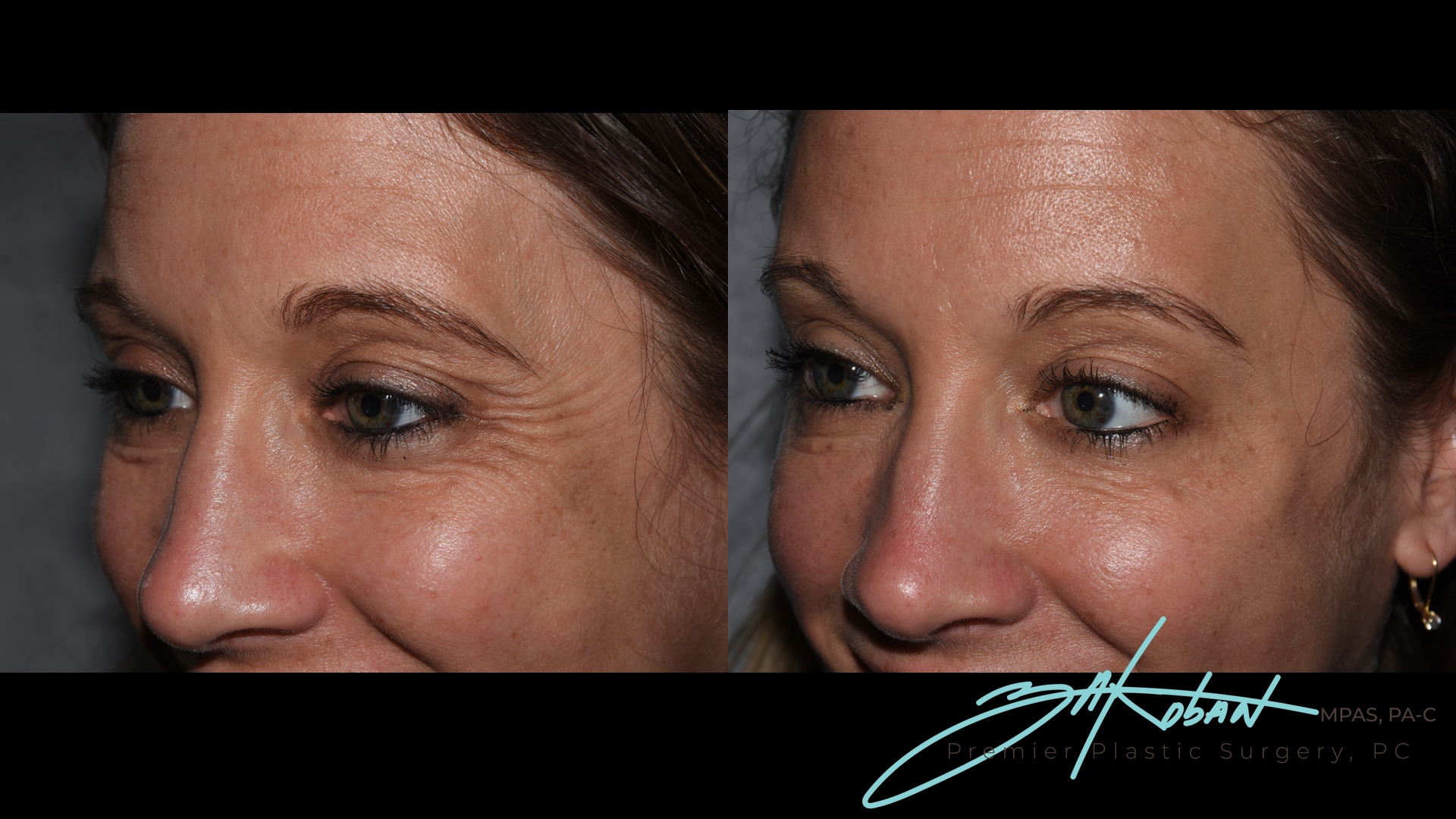 Dysport Before and After | Premier Plastic Surgery