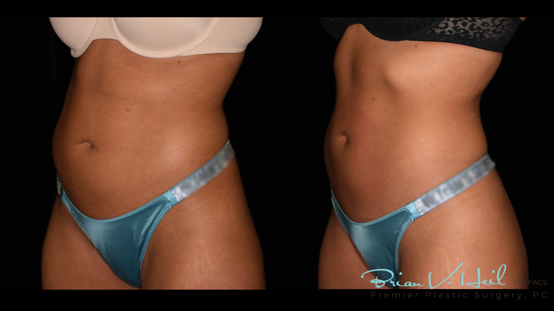 Emsculpt Neo Before and After | Premier Plastic Surgery
