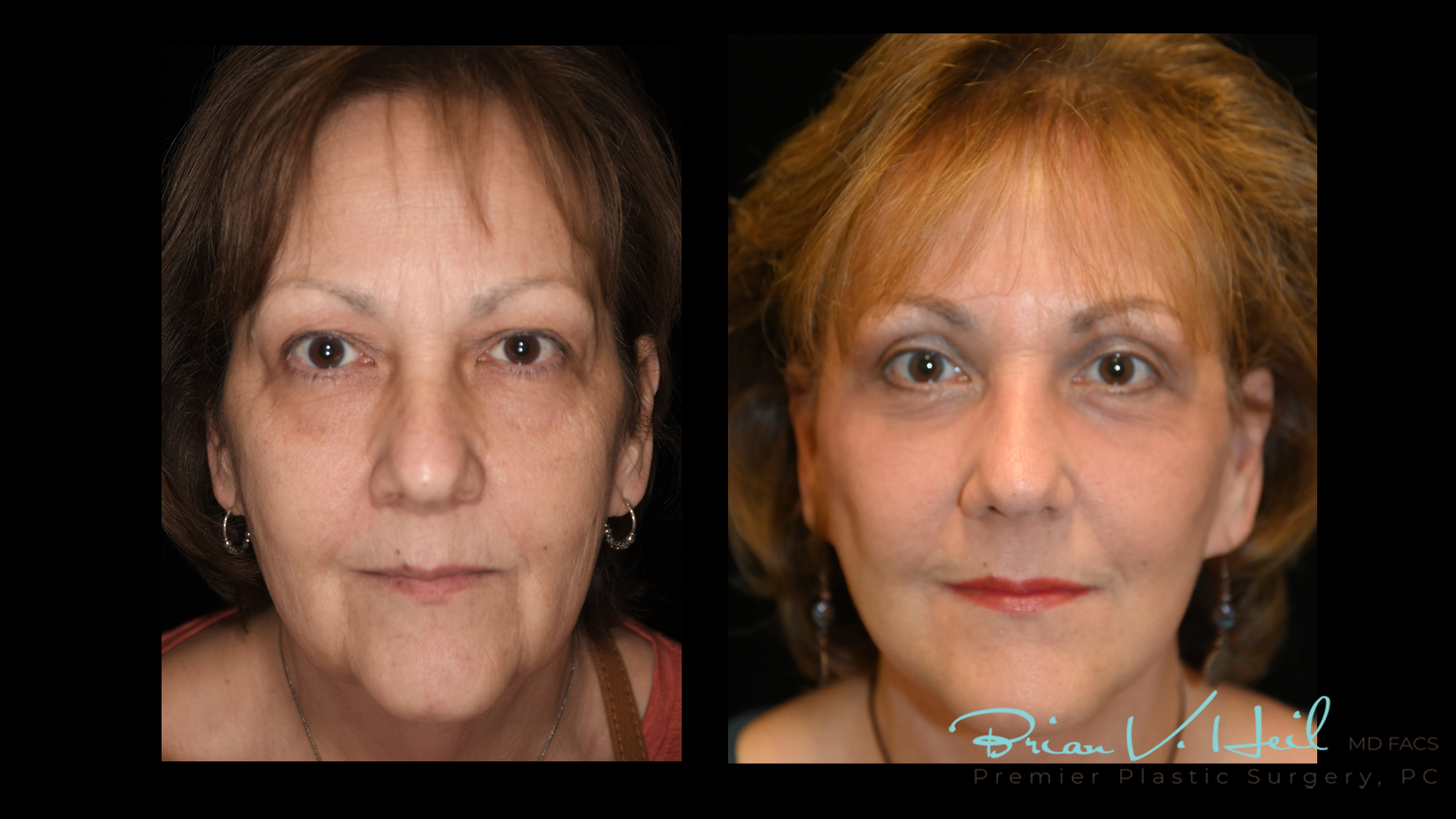 Facelift Surgery in Pittsburgh, PA