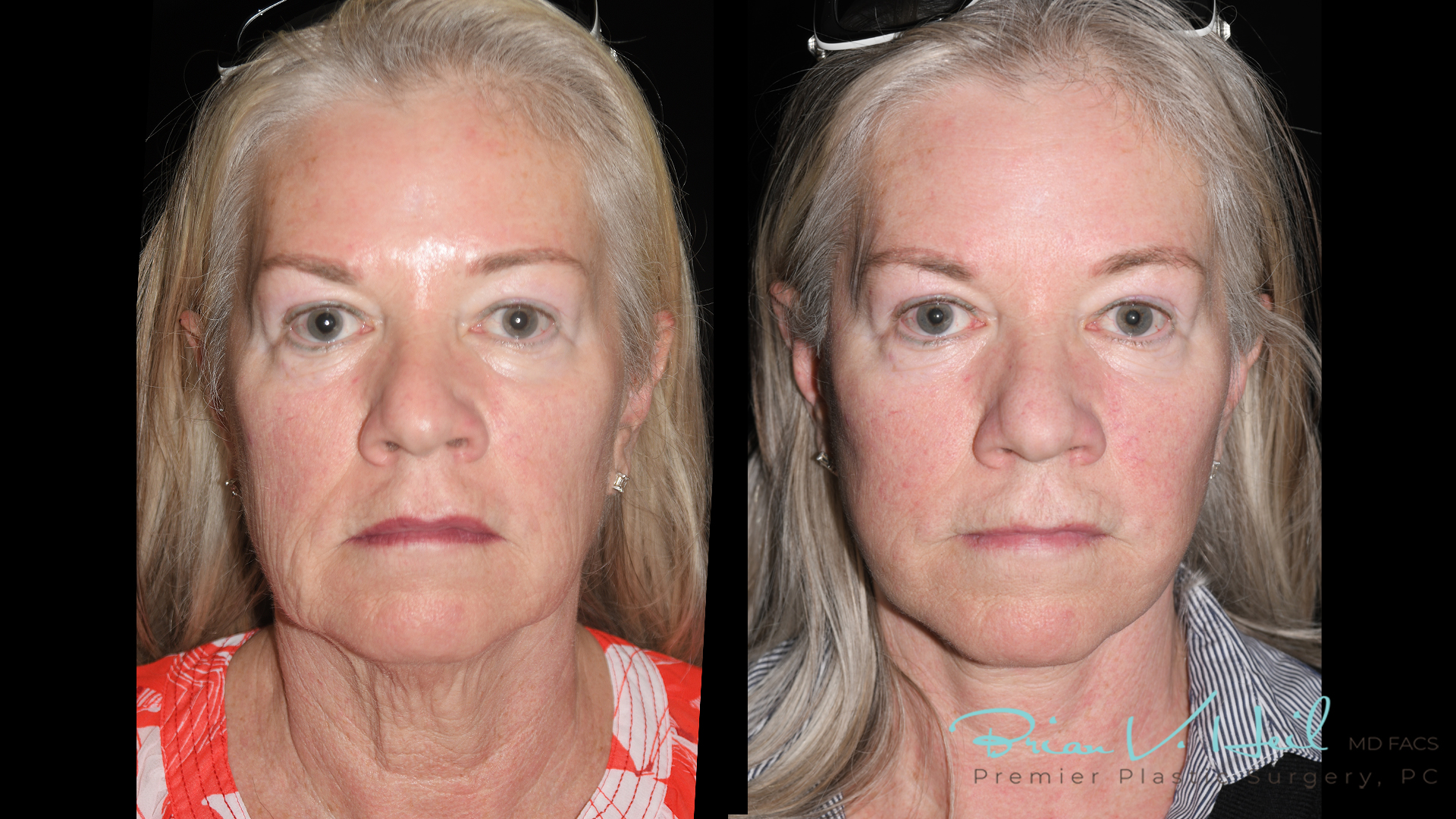Facelift Surgery in Pittsburgh, PA