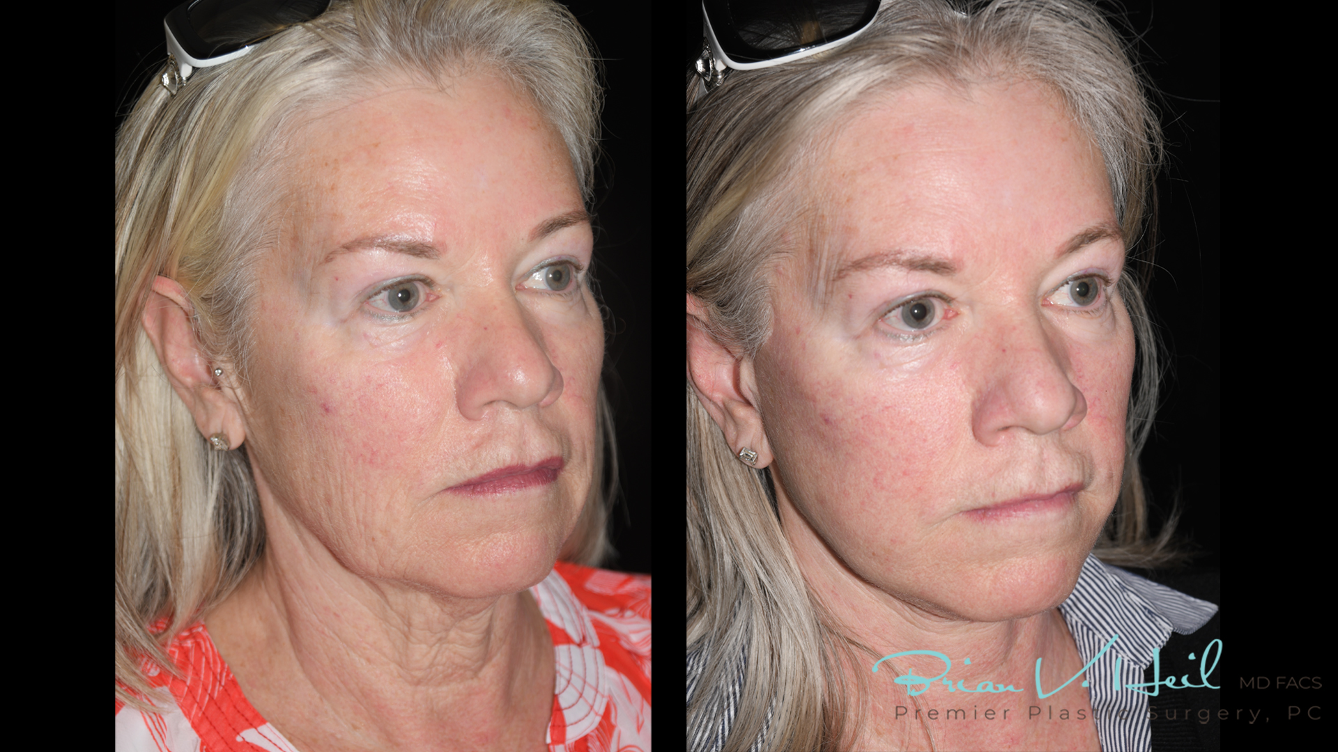 Facelift Surgery in Pittsburgh, PA