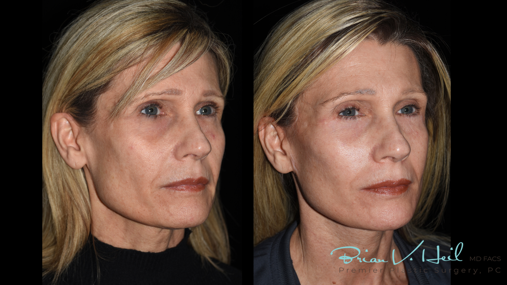 Face/Neck Lift Before and After | Premier Plastic Surgery