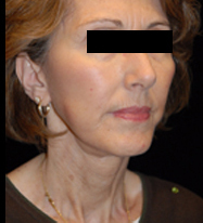 Face/Neck Lift Before and After | Premier Plastic Surgery
