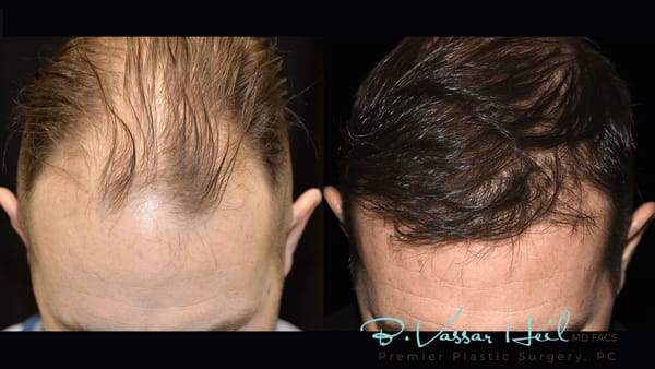 Featured Before and After | Premier Plastic Surgery