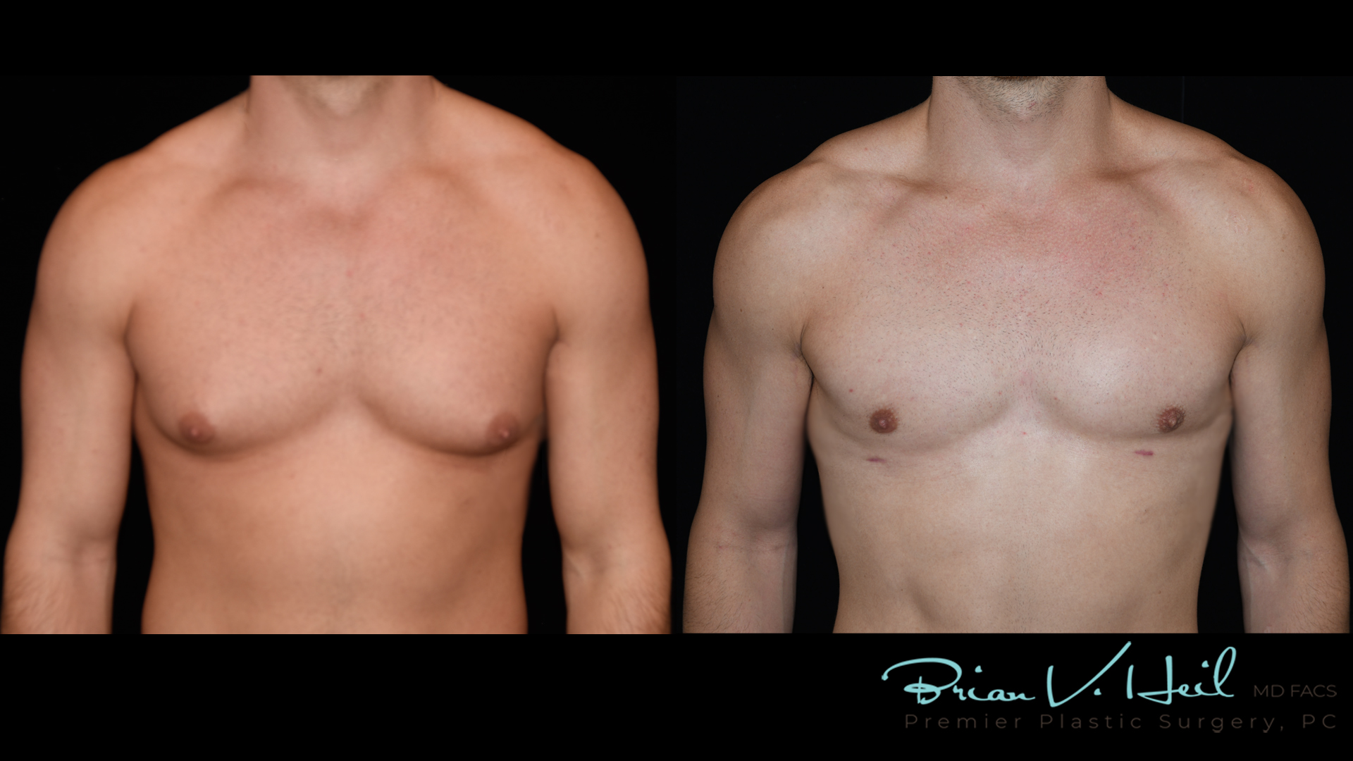 Gynecomastia in Pittsburgh, PA