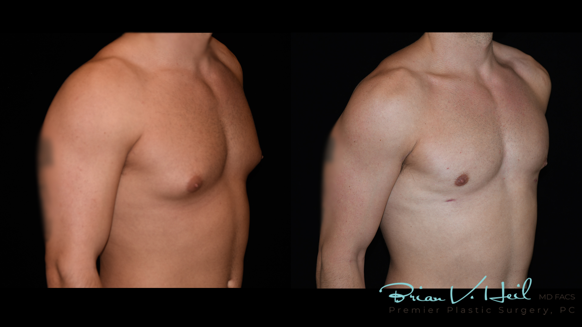 Gynecomastia in Pittsburgh, PA