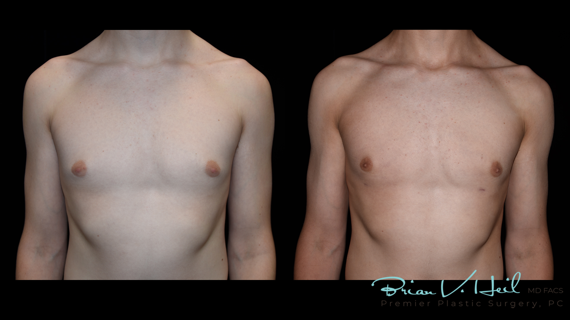 Gynecomastia in Pittsburgh, PA