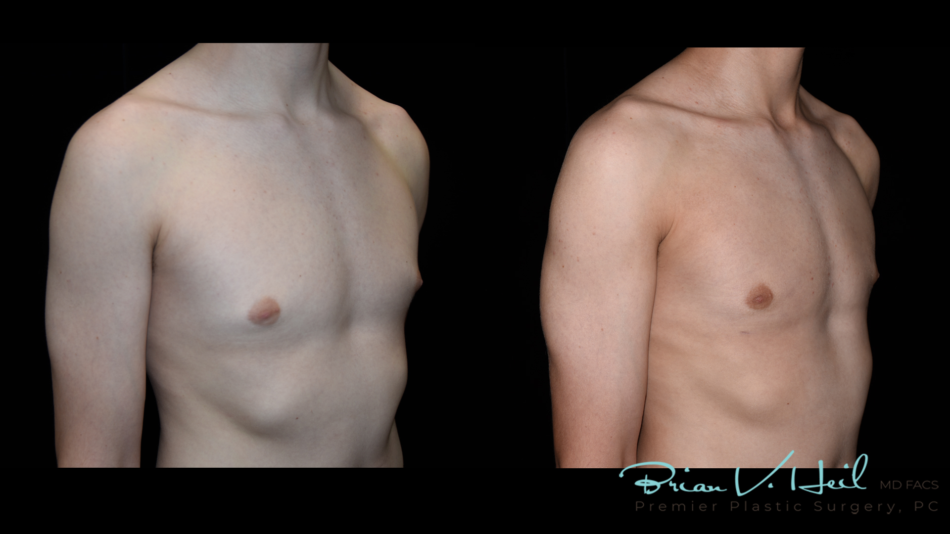 Gynecomastia in Pittsburgh, PA