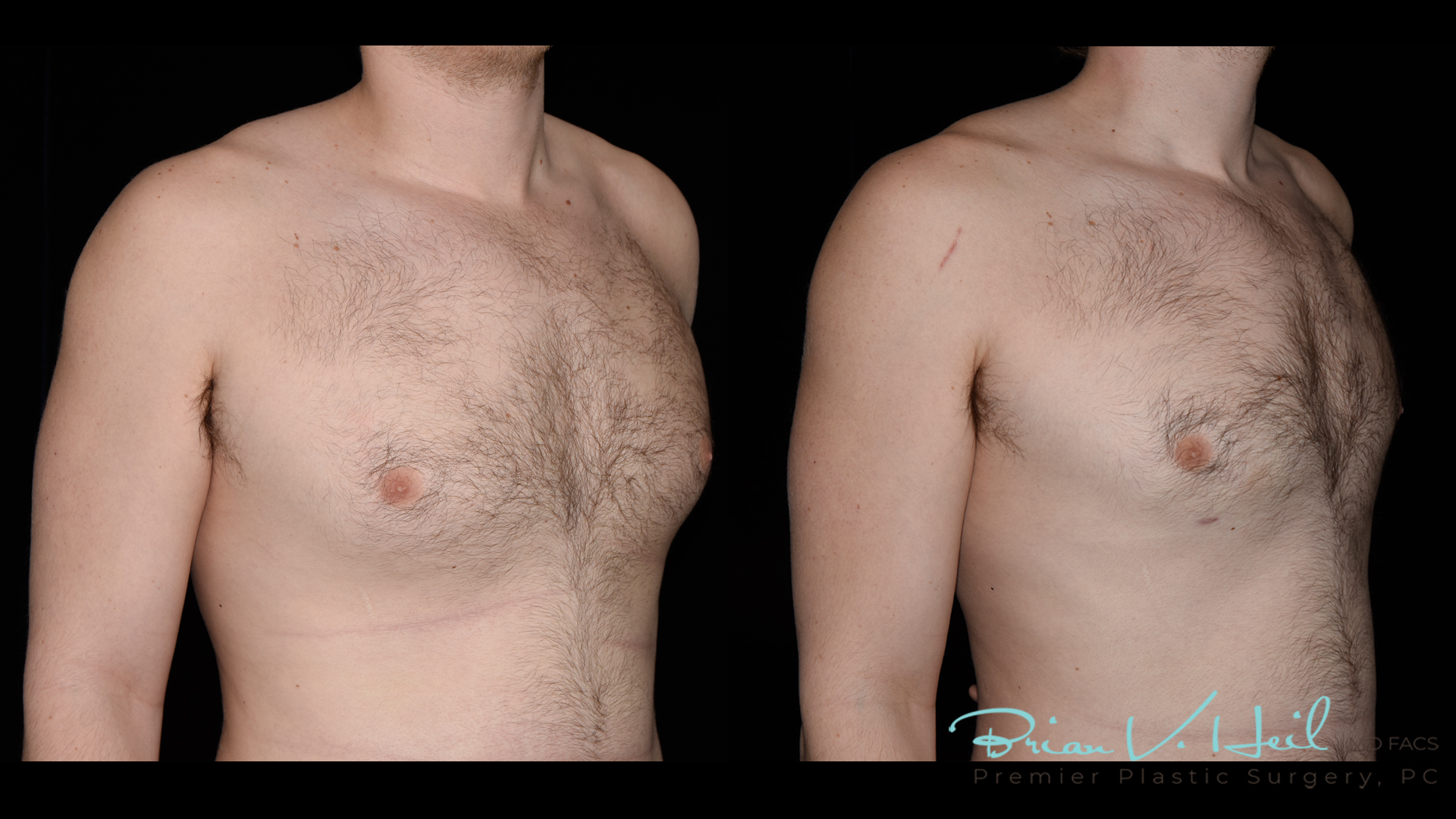 Gynecomastia Before and After | Premier Plastic Surgery