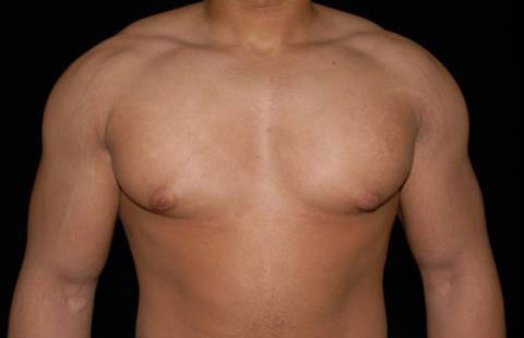 Gynecomastia Before and After | Premier Plastic Surgery