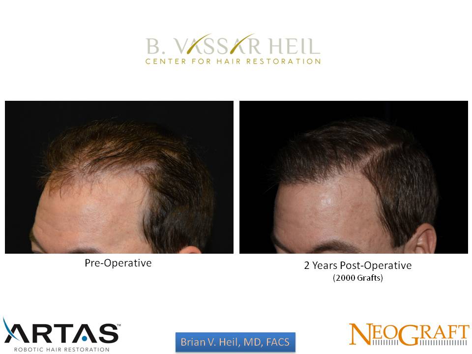 Hair Restoration Gallery Before and After | Premier Plastic Surgery