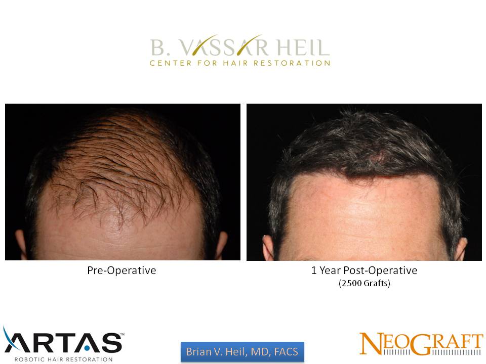 Hair Restoration Gallery Before and After | Premier Plastic Surgery