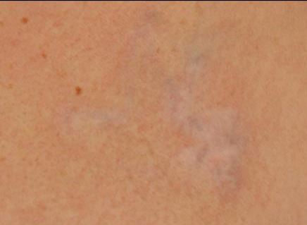 Laser Tattoo Removal Before and After | Premier Plastic Surgery