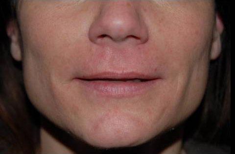 Lip Augmentation Before and After | Premier Plastic Surgery