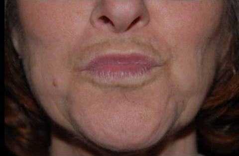 Lip Augmentation Before and After | Premier Plastic Surgery