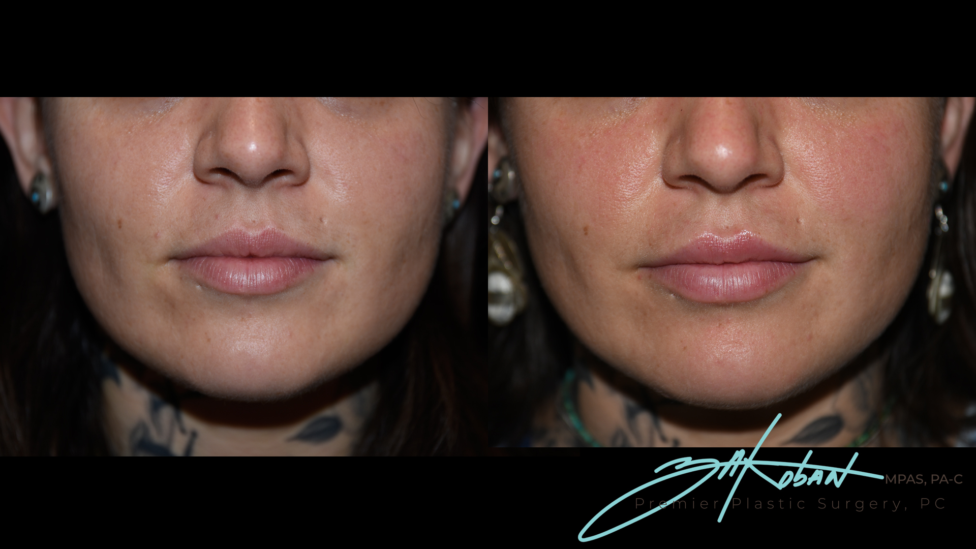 Lip Filler Before and After | Premier Plastic Surgery