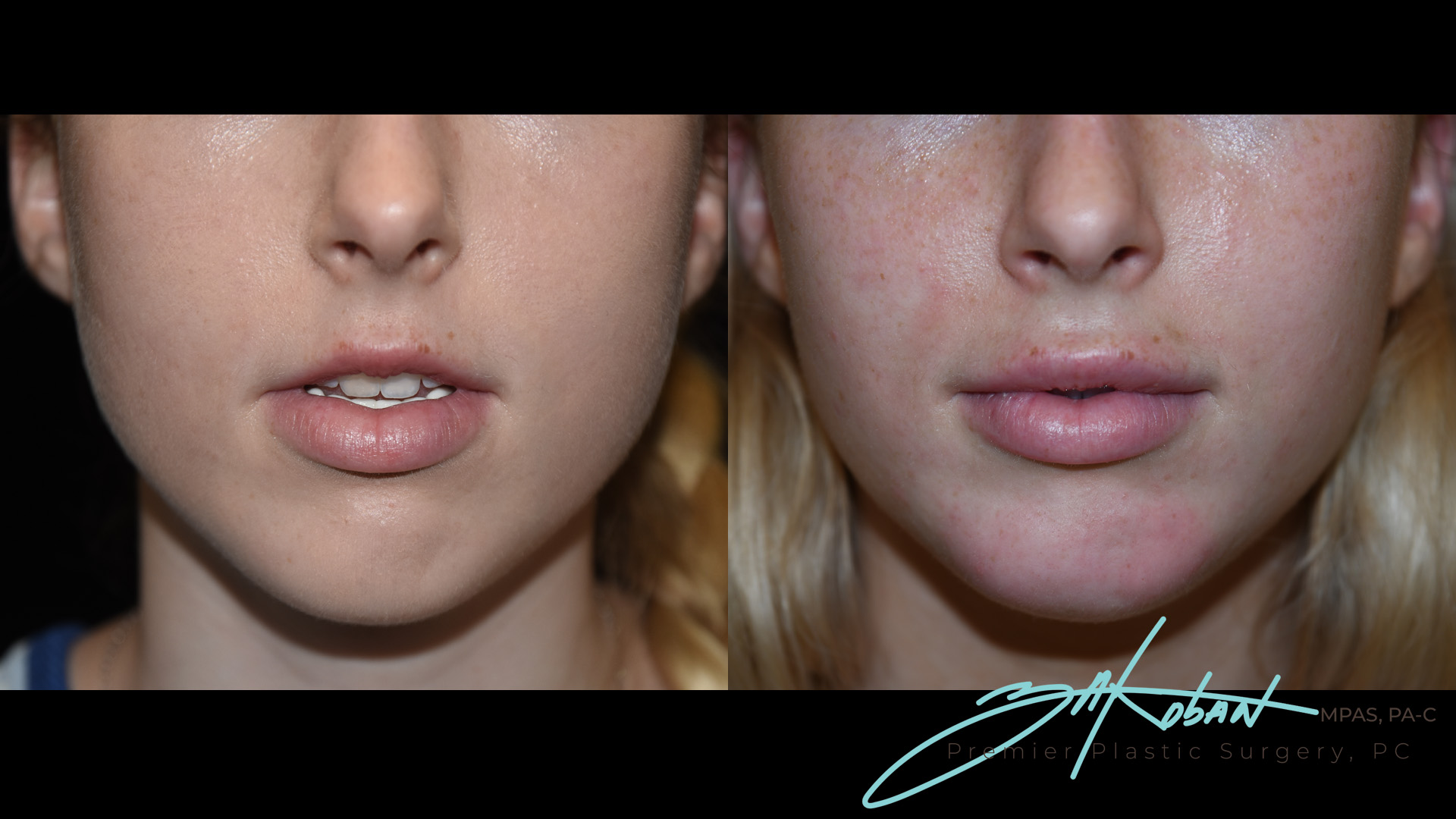 Lip Filler Before and After | Premier Plastic Surgery