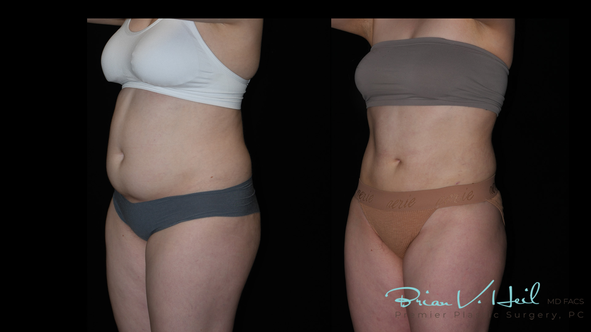 Liposuction Before and After | Premier Plastic Surgery