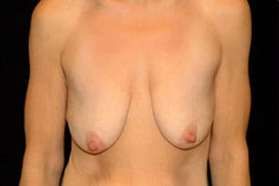 Mastopexy Before and After | Premier Plastic Surgery