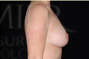 Mastopexy Before and After | Premier Plastic Surgery