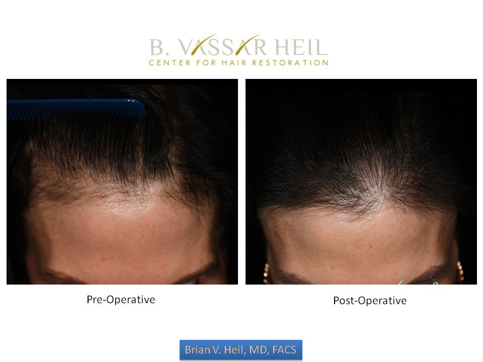 Prp Before and After | Premier Plastic Surgery