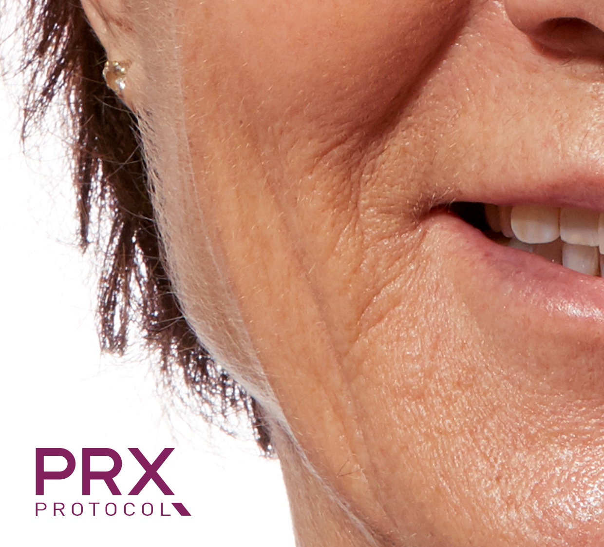 Prx Derm Perfexion Before and After | Premier Plastic Surgery