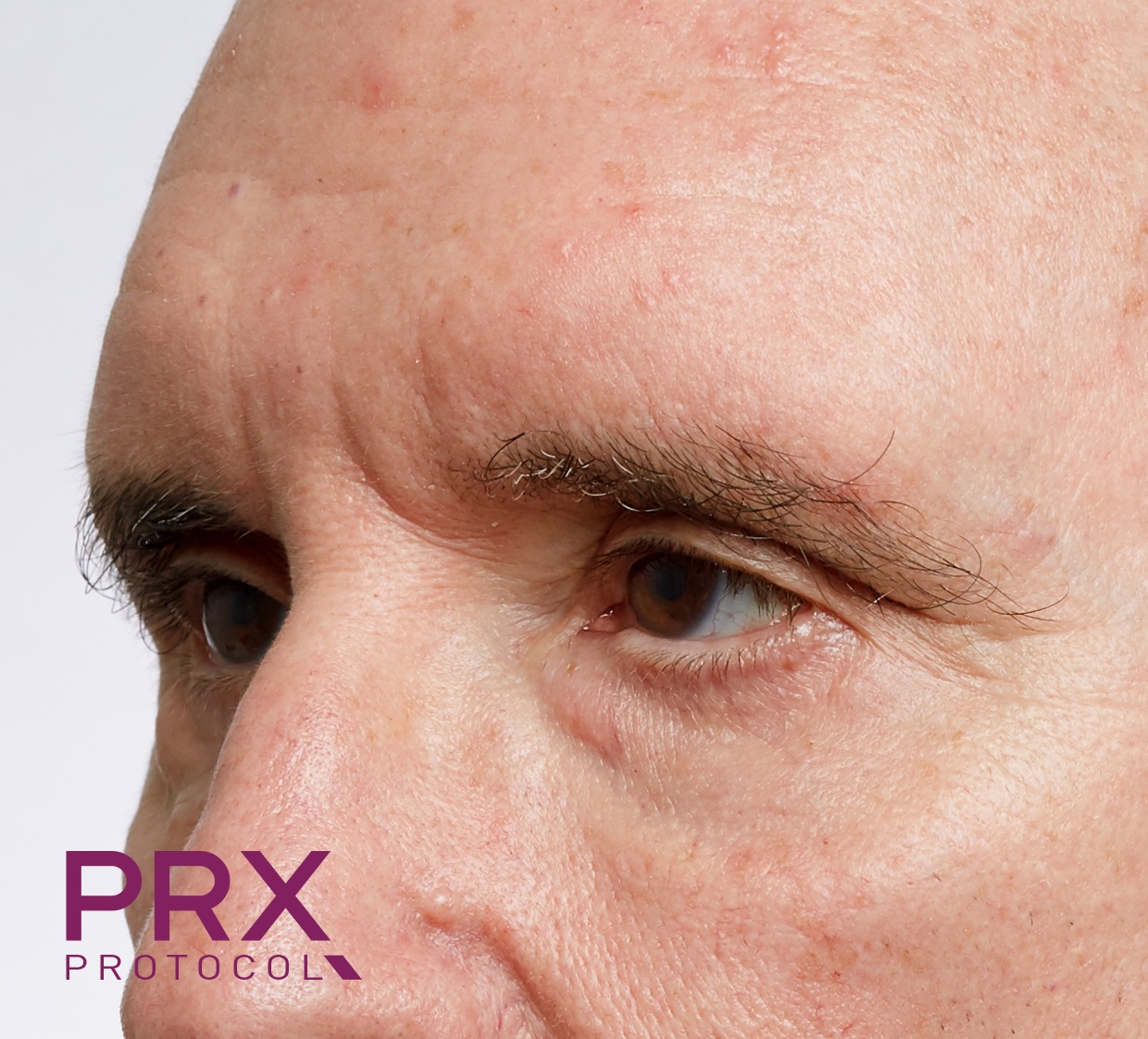 Prx Derm Perfexion Before and After | Premier Plastic Surgery